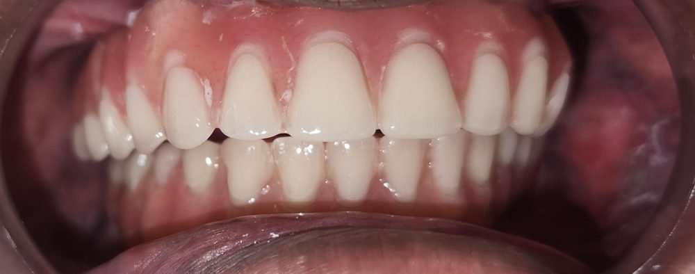 Upper and lower fixed implant-supported teeth meeting together in the bite