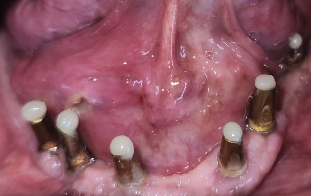 Lower jaw after 4 months of healing, with connecting parts (abutments) fitted on the dental implants