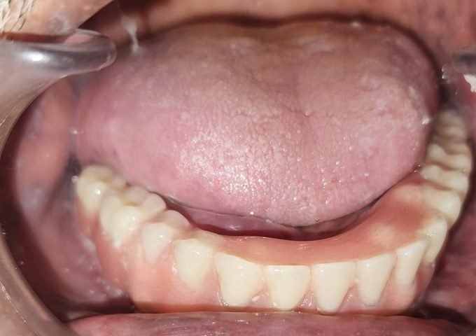 Fixed lower hybrid denture attached to the implants in the lower jaw