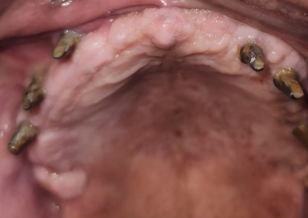 Upper jaw after 4 months of healing, with connecting parts (abutments) fitted on the dental implants