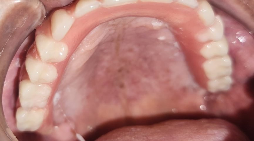 Fixed upper hybrid denture attached to the implants in the upper jaw, seen from below