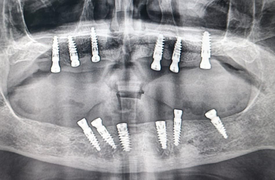 Panoramic X-ray after surgery showing dental implants placed in both the upper and lower jaws