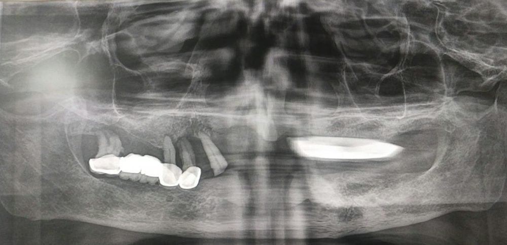 Panoramic dental X-ray before treatment showing a few remaining loose teeth with existing dental work and missing teeth in both jaws