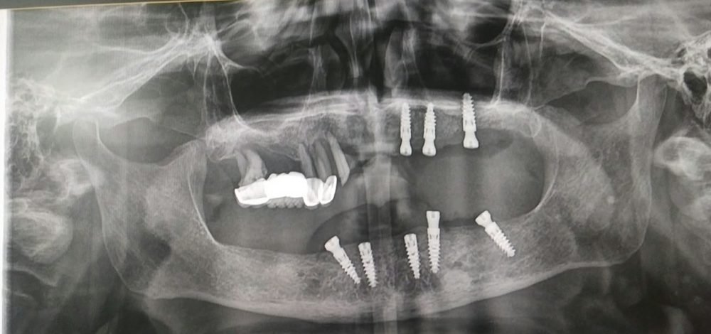 Panoramic X-ray taken during the implant phase, showing implants placed in the lower jaw and front of the upper jaw while some natural teeth remain