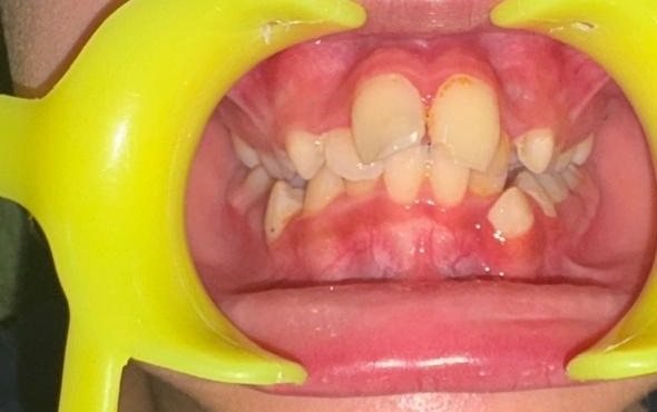 Front view of a child’s teeth with a cheek retractor: upper front teeth protrude and the lateral incisors and canines are crowded outside the arch