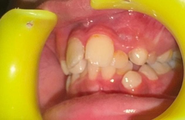 Left-side view of a child’s teeth showing the same protrusion and crowding, with retained milk teeth still in place