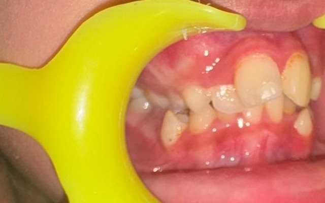 Right-side view of a child’s teeth showing proclined upper incisors and the crowding they create
