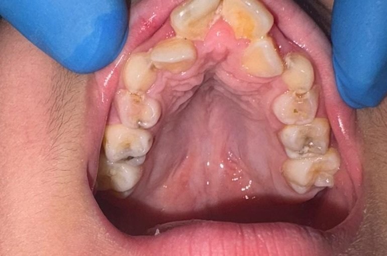 View of the roof of a child’s mouth showing a narrow, tapered V-shaped upper dental arch with a high, constricted palate