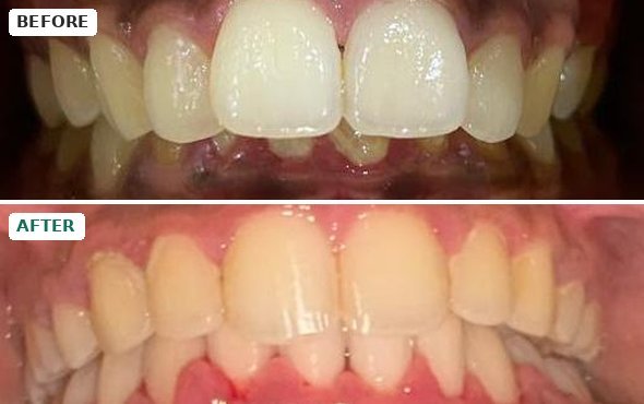 Before and after braces: a 13-year-old’s protruding upper front teeth and deep bite corrected with premolar extraction