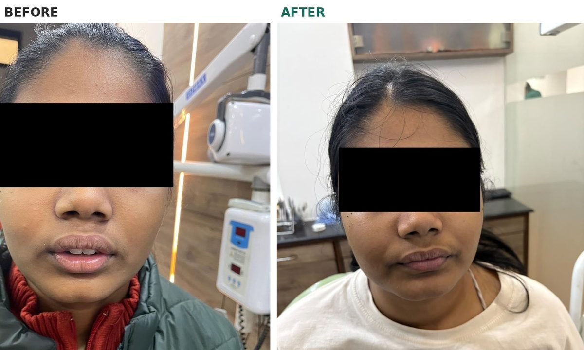Before and after braces, face at rest with eyes masked: before, the lips are apart and the upper front teeth show; after, the lips close comfortably