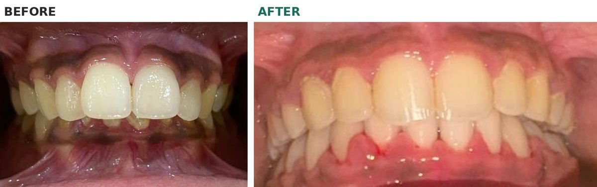 Front view of the teeth before and after braces: before, the upper front teeth hide almost all of the lower teeth; after, the deep bite is opened