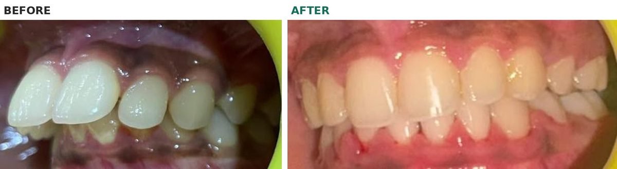 Left side of the teeth before and after braces with premolar extraction, showing the corrected overjet and bite