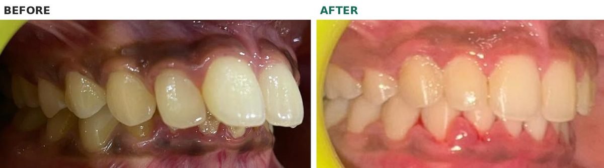Right side of the teeth before and after braces: before, the upper front teeth are tipped forward; after, they sit back over the lower teeth