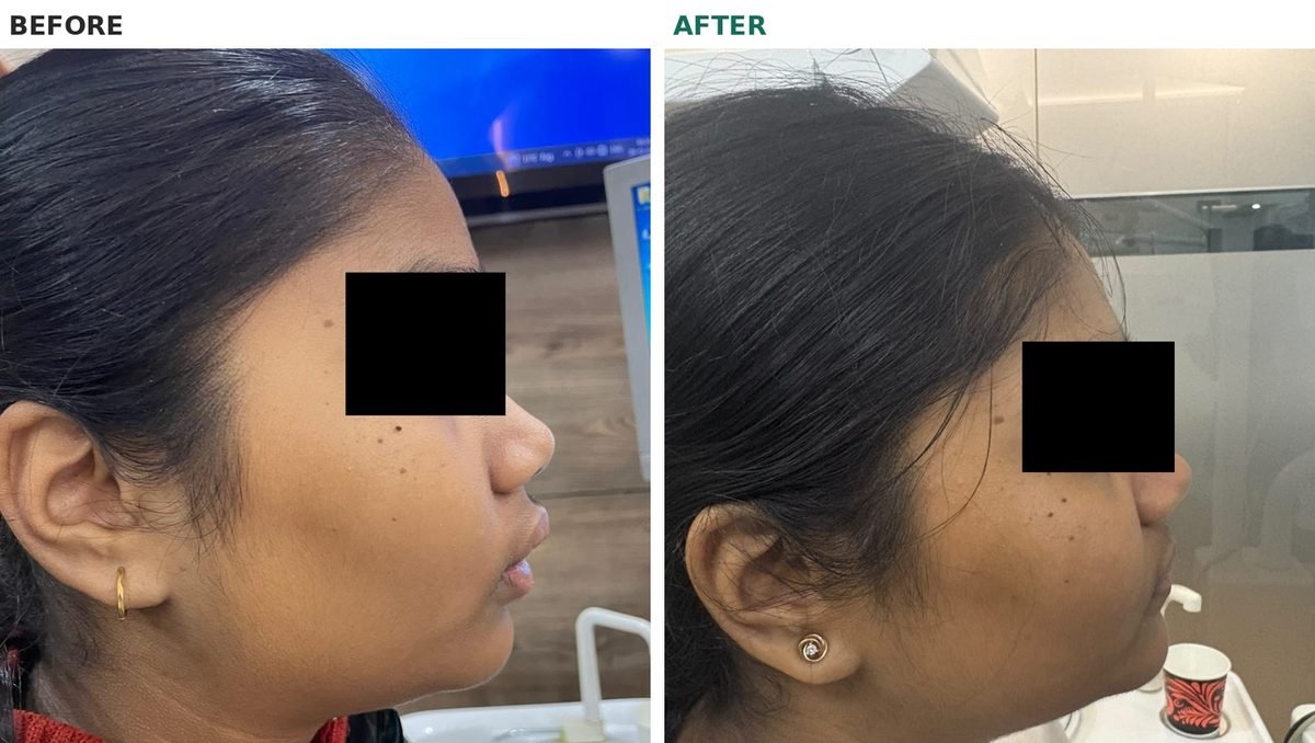 Before and after braces with premolar extraction, side profile at rest with eyes masked, showing less prominent lips after treatment