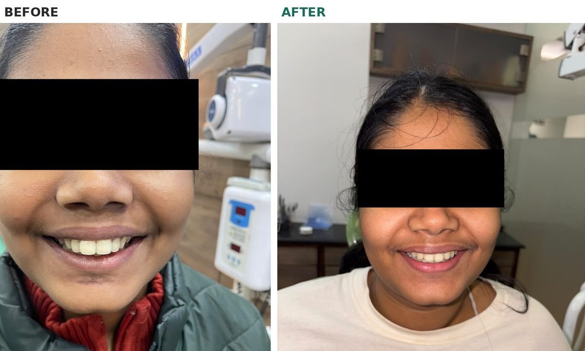 Before and after orthodontic treatment, front smile with eyes masked, showing aligned and less prominent upper front teeth