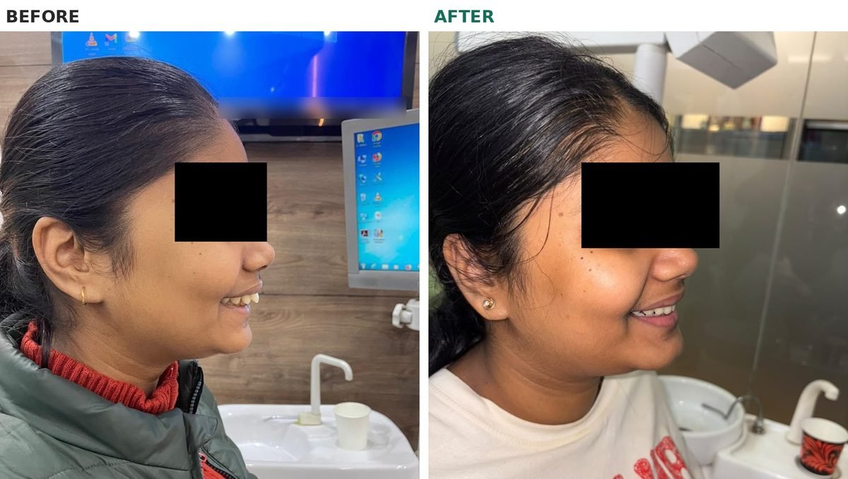 Before and after braces, smiling side profile with eyes masked: before, the upper front teeth stick out past the lips; after, they sit behind the lips