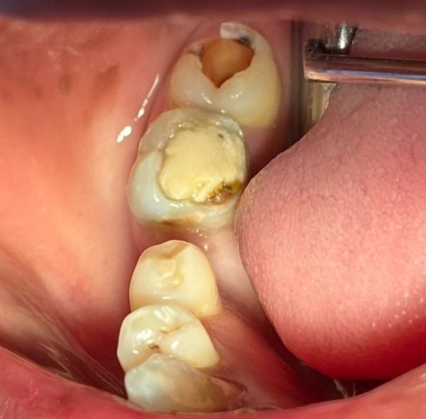 Back teeth on one side of the jaw: the wisdom tooth with a deep brown cavity in its biting surface, the second molar behind it with a large filling, and a gap where the first molar is missing