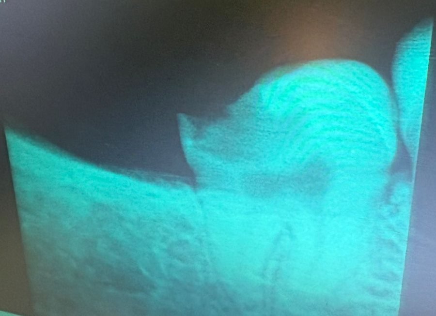 Dental X-ray of the wisdom tooth before treatment, showing a dark area of decay running from the biting surface down towards the pulp chamber