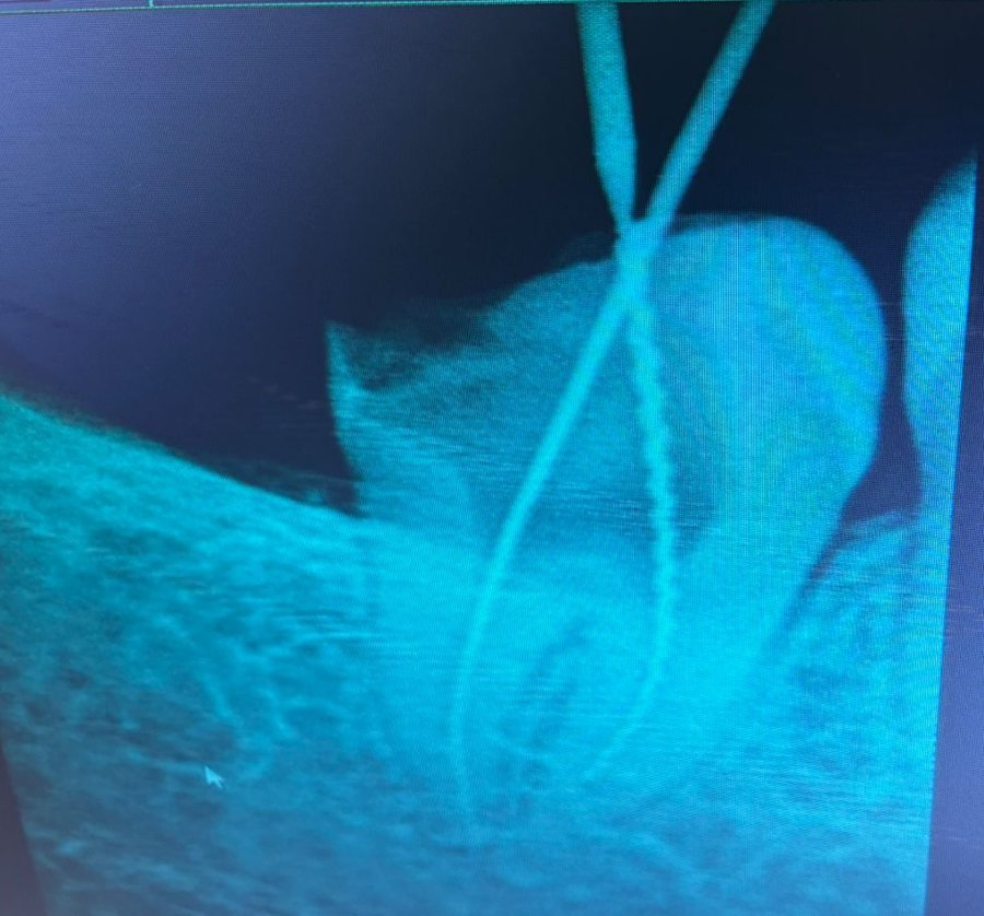 Dental X-ray taken during root canal treatment, with two fine instruments placed in the canals of the wisdom tooth to measure their length